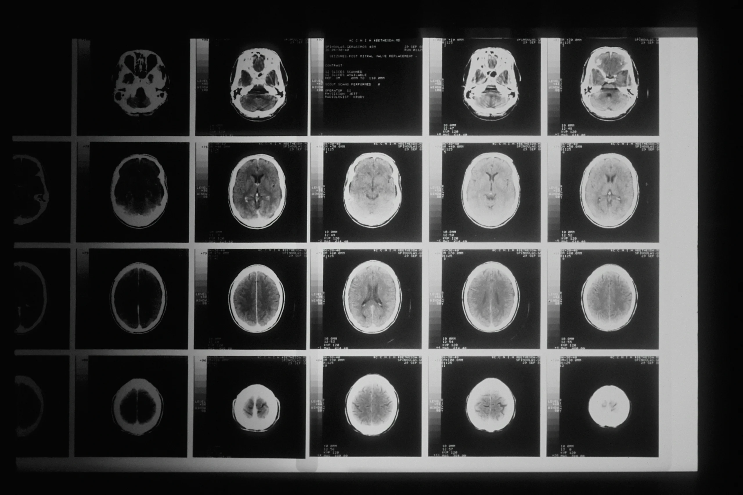 pet scan